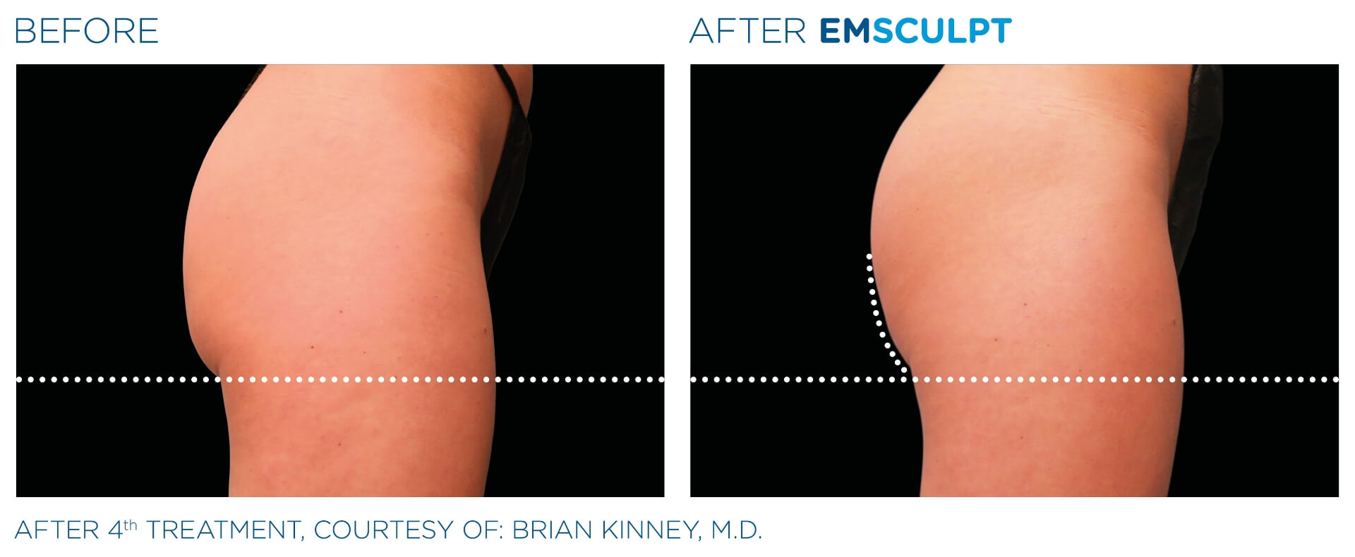 Before and after results for EMSCULPT