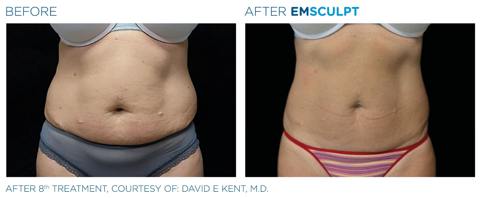 Before and after EMSCULPT treatments