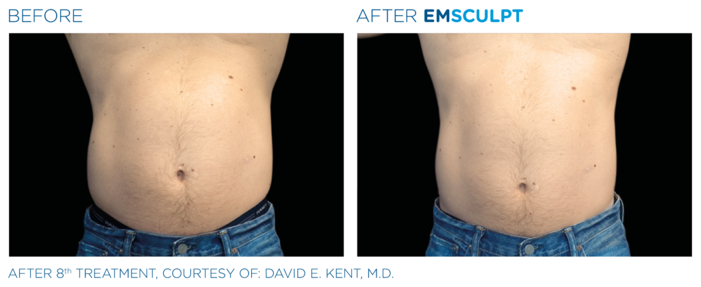 Before and after EMSCULPT results