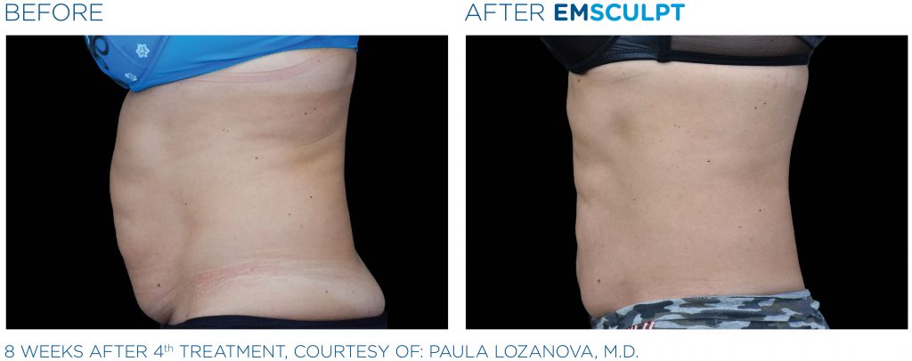 Before and after results for EMSCULPT