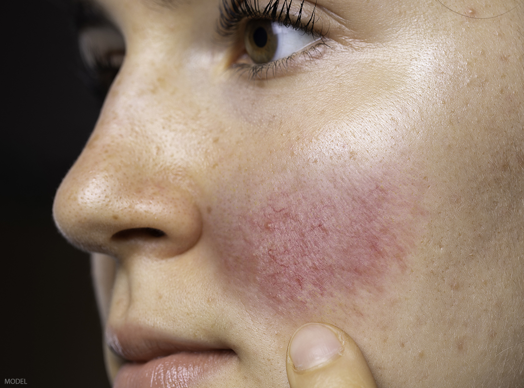 All About Rosacea Dermphysicians Of New England 