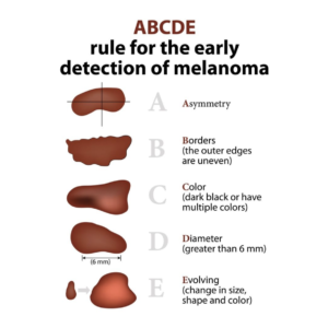 The ABCDEs of Melanoma