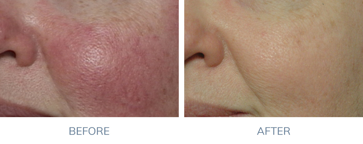 VBeam Rosacea Before and After