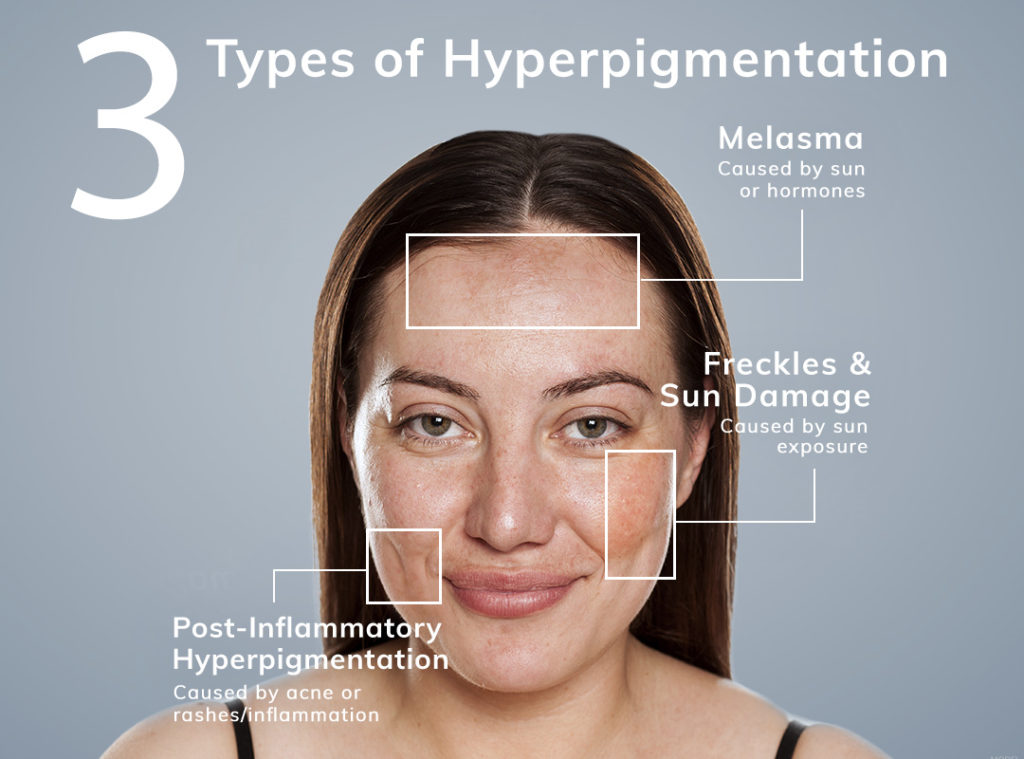 Woman with Hyperpigmentation