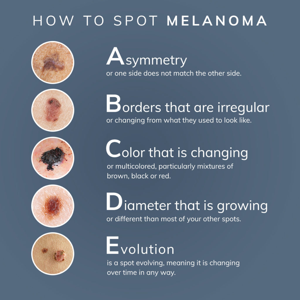 Melanoma What You Need To Know DermPhysicians Of New England