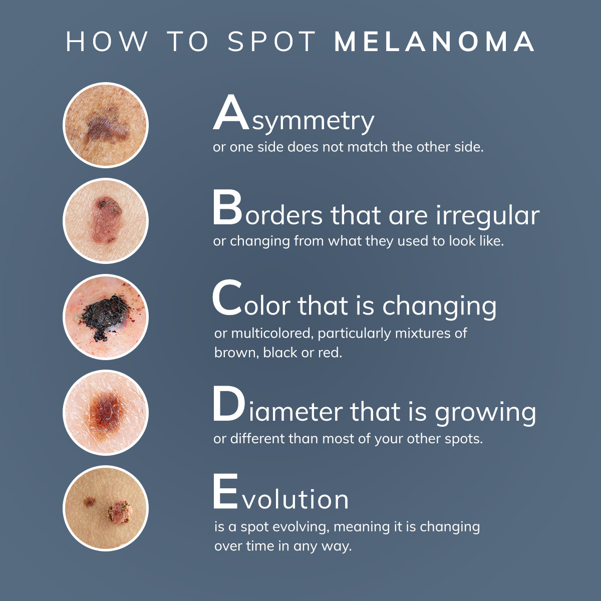 The ABCDEs of spotting melanoma