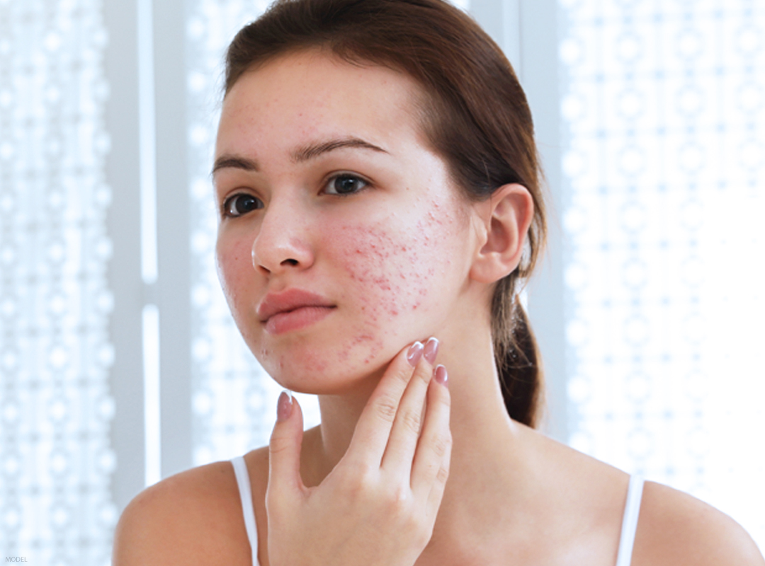 Acne Awareness at Any Age - DermPhysicians of New England