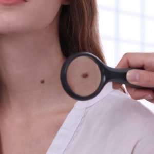 Melanoma: What You Need to Know