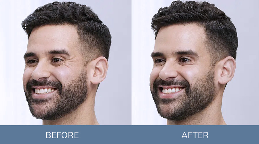 Before and after images of a man who got Botox for crow's feet