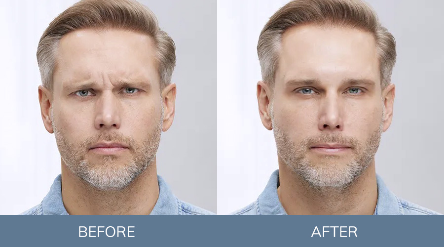 Before and after images of a man who got Botox for frown lines