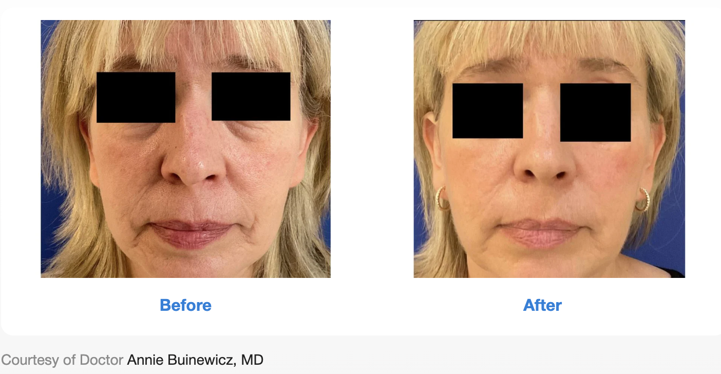 Before and after results for Sofwave