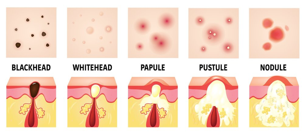 Illustrations of the different types of acne for Acne Awareness Month