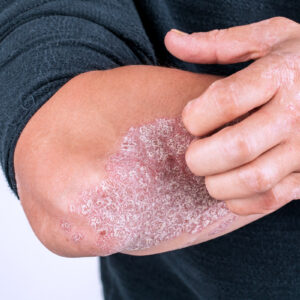 Psoriasis Awareness