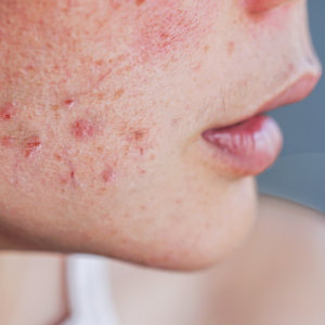 Viral Skincare “Hacks”: What to Know Before Trying Them at Home